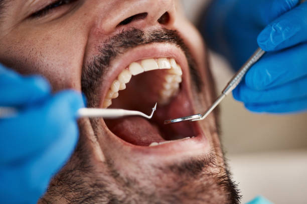 Best Emergency Dentist for Lost Fillings or Crowns in Haliimaile, HI
